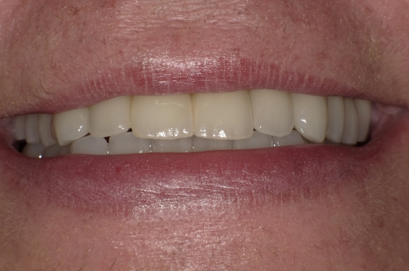 Ersatz der fehlenden Zähne mit Implantaten und Komplettversorgung mit vollkeramischen Restaurationen und Wiederherstellung der ursprünglichen Höhe